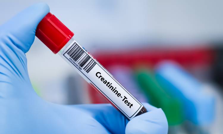Kreatynina - co to za badanie i o czym świadczy jej poziom?