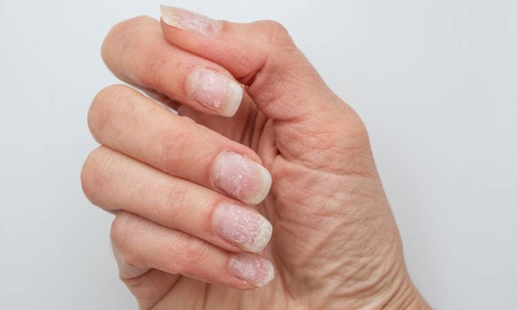 Zniszczone paznokcie po hybrydzie - jak szybko i skutecznie je wzmocnić?