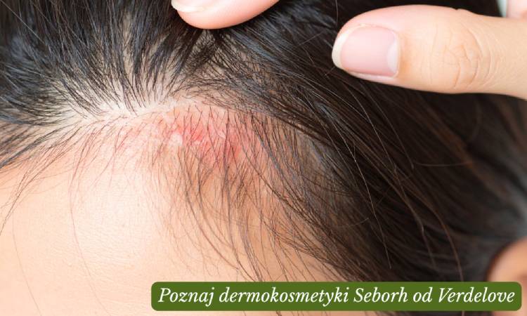 Łojotokowe zapalenie skóry głowy – sprawdź, co naprawdę pomaga