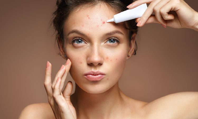 Kwas azelainowy od A do Z – jak działa na trądzik i przebarwienia? Kompendium wiedzy