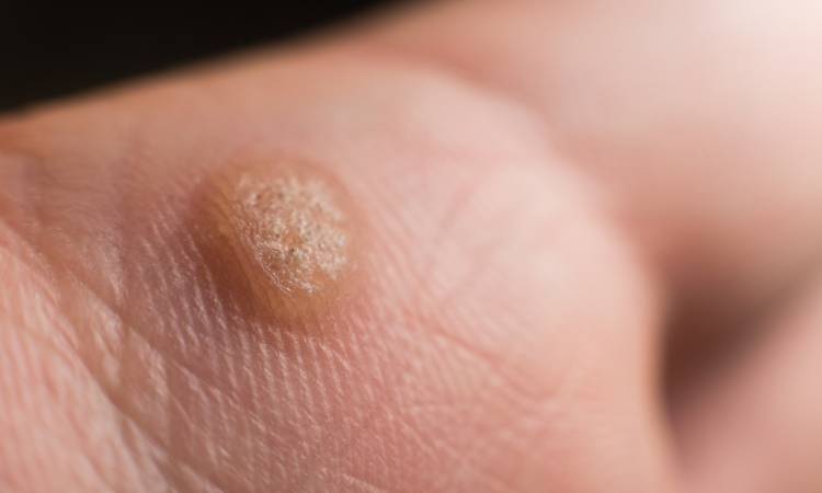 Kurzajki – jak rozpoznać brodawki wirusowe i skutecznie się ich pozbyć?