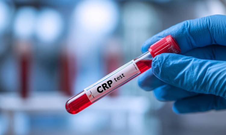 CRP – co to za badanie? Normy, interpretacja wyników i przyczyny podwyższonego białka C-reaktywnego
