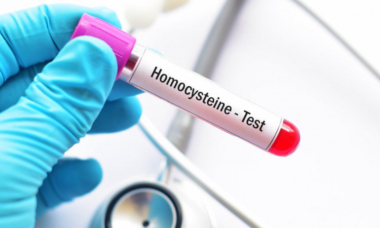 Homocysteina – jakie są normy w badaniu krwi? Problem z wysokim poziomem homocysteiny.