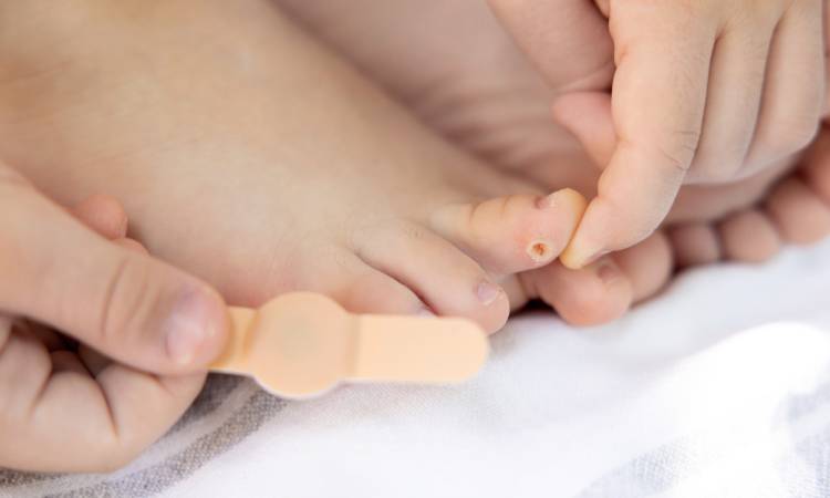 Odcisk między palcami u stopy - przyczyny, rodzaje i skuteczne sposoby usuwania