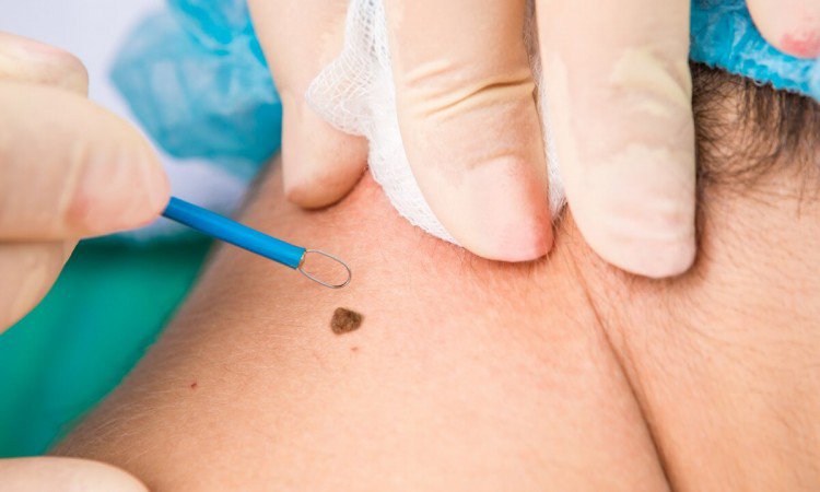 Czym jest czerniak oraz jakie są jego objawy i diagnostyka?