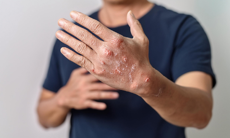 Egzema skóry – czym jest, jak ją rozpoznać i skutecznie leczyć? Kompletny przewodnik