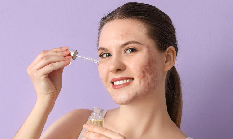 Przebarwienia po trądziku – rodzaje, przyczyny i sprawdzone sposoby usuwania śladów