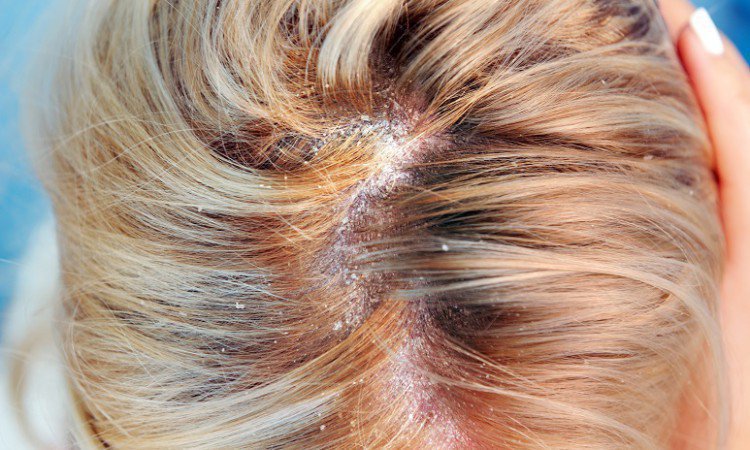 Łojotokowe zapalenie skóry: leczenie, objawy i przyczyny ŁZS - uciążliwej dermatozy