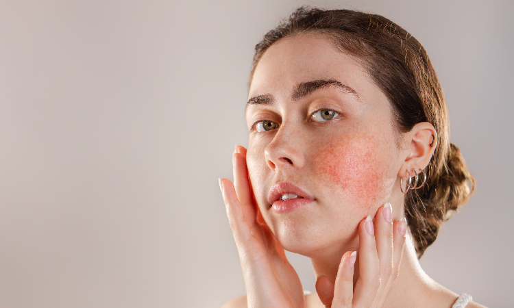 Trądzik różowaty – jak rozpoznać objawy i skutecznie leczyć tę dermatozę?