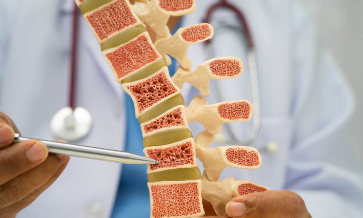 Osteoporoza – mało znana, a wyjątkowo poważna i powszechna choroba naszych kości