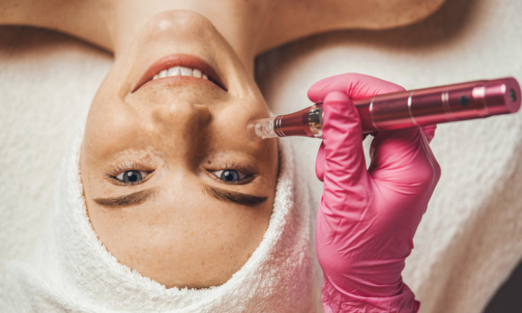 Mezoterapia mikroigłowa – na czym polega i jak działa na skórę?