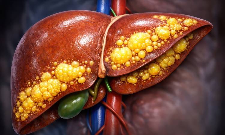 Niealkoholowe stłuszczenie wątroby (NAFLD) – jakie są objawy i jak leczyć?