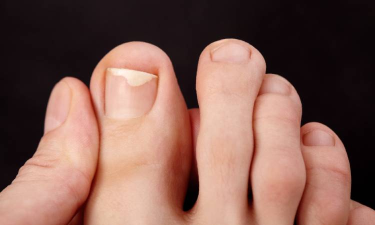 Onycholiza paznokci – jak rozpoznać odklejanie się płytki i jak je skutecznie leczyć?