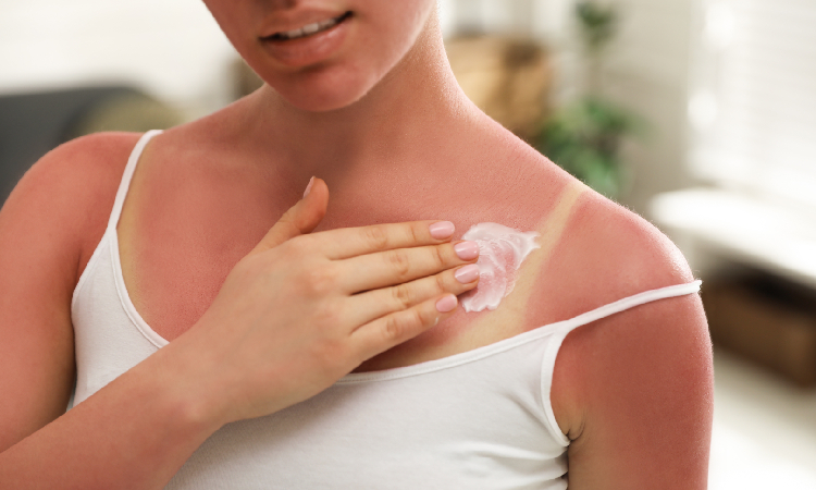 Oparzenia słoneczne - jak szybko złagodzić ból i wyleczyć skórę?