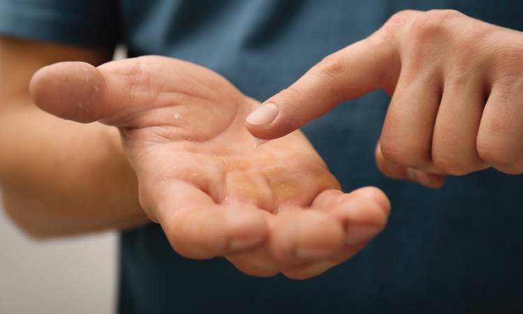 Odciski na dłoniach - przyczyny, rodzaje i skuteczne metody usuwania